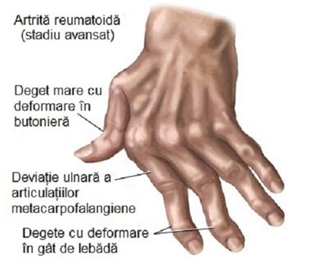 simptomele artritei reumatoide la încheietura mâinii